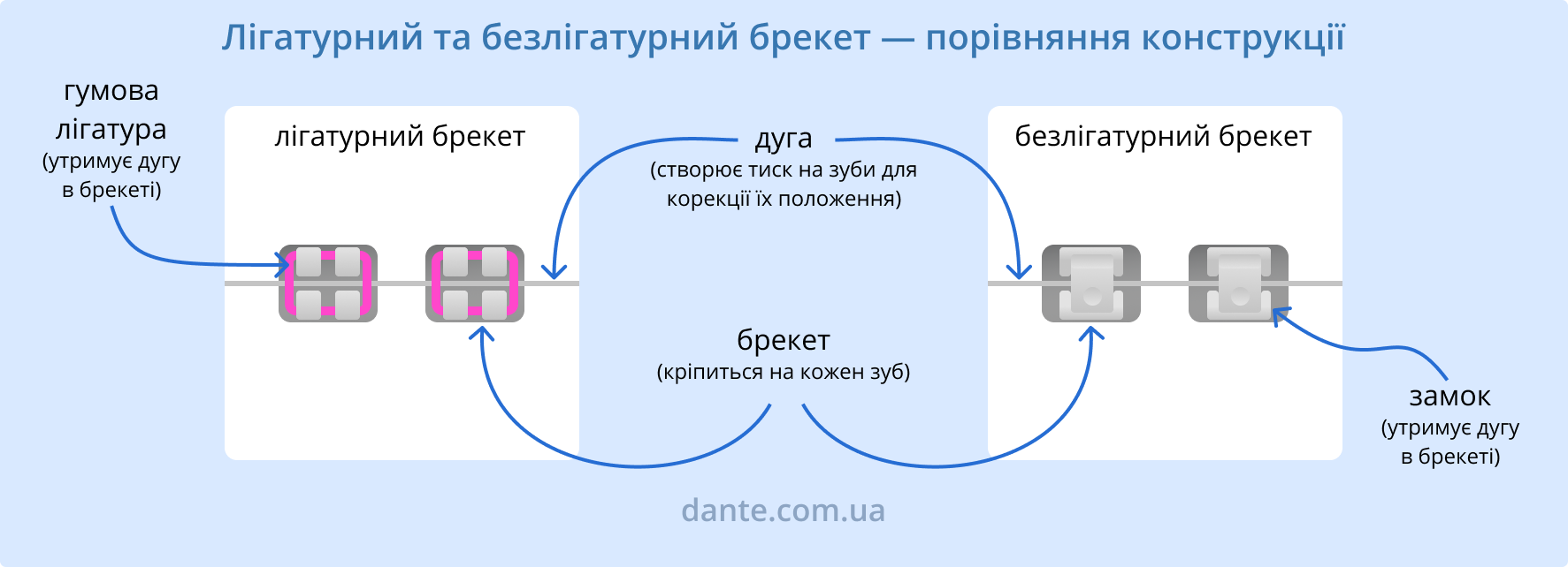 Лігатурний та безлігатурний брекет — порівняння конструкції | Ортодонтія | Стоматологія D.Ante