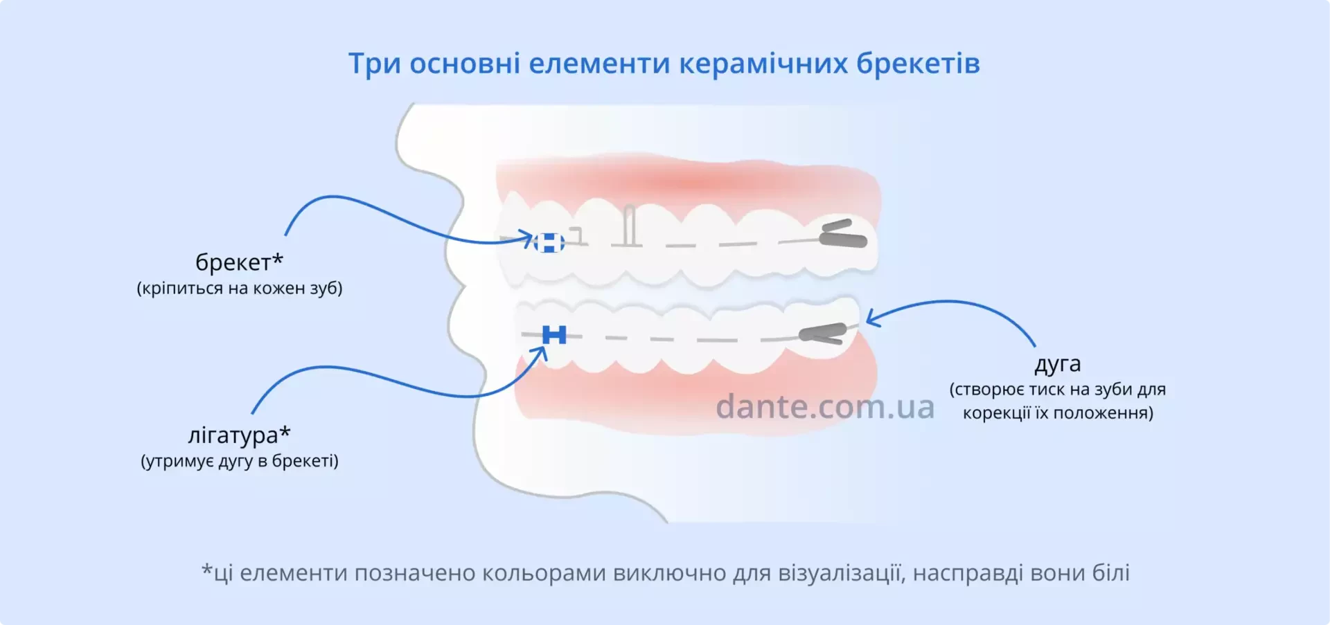 З чого складаються керамічні брекети | Ортодонтія | Стоматологія D.Ante