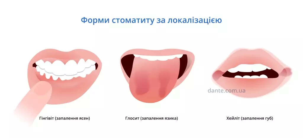 Локалізація стоматиту (форми стоматиту)