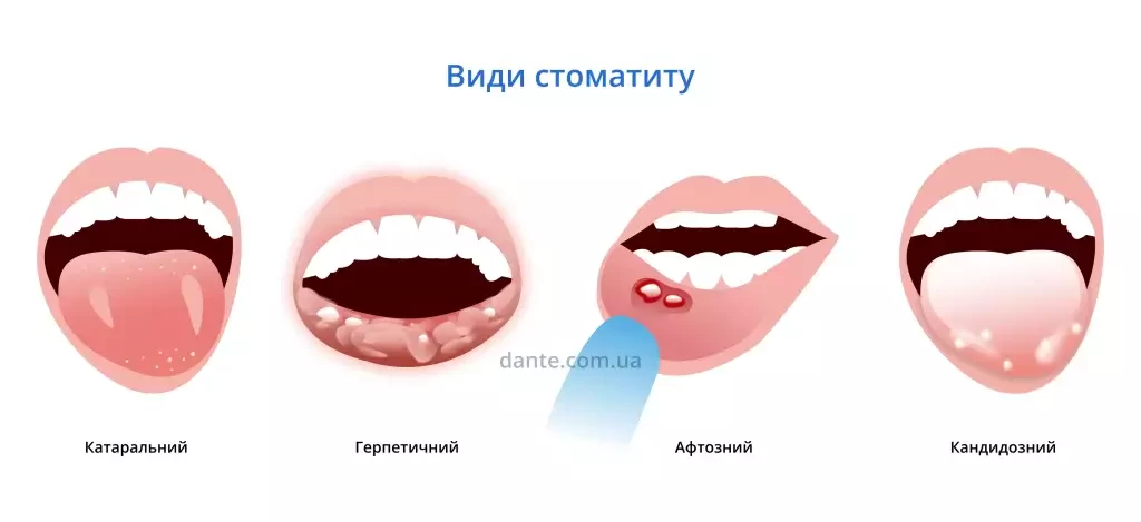 стоматит види