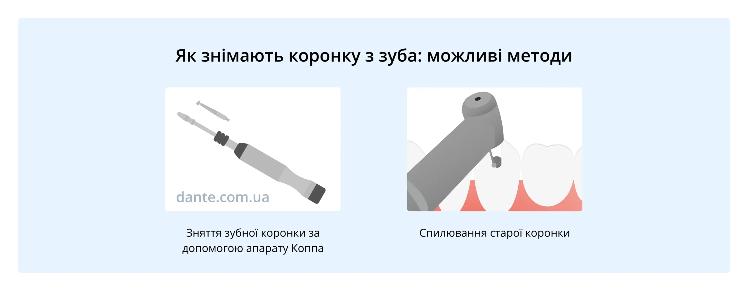 зняття коронки зуба