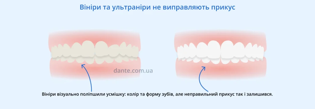 як впливають вініри та ультраніри на прикус