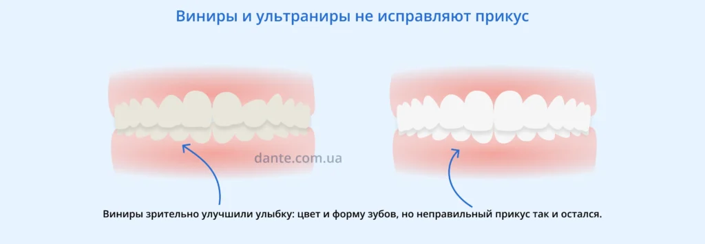 как влияют виниры и ультраниры на прикус