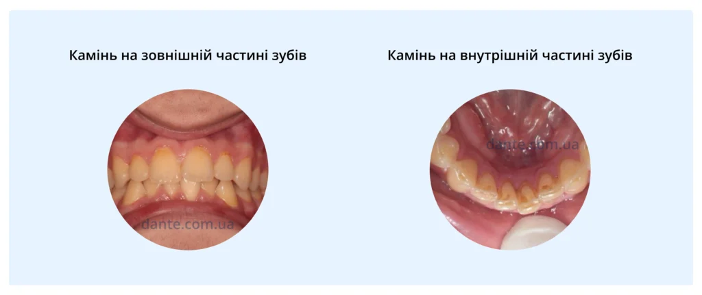 Як виглядає зубний камінь на внутрішньому та зовнішньому боці зубів: жовті та темні відкладення на зубах