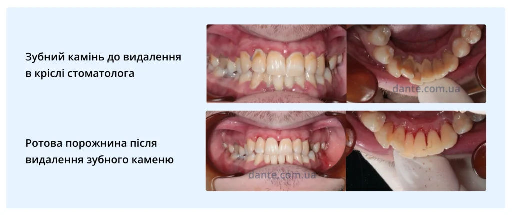 Зубний камінь до та після видалення: як змінюється естетика ротової порожнини після видалення зубного каменю в кріслі стоматолога