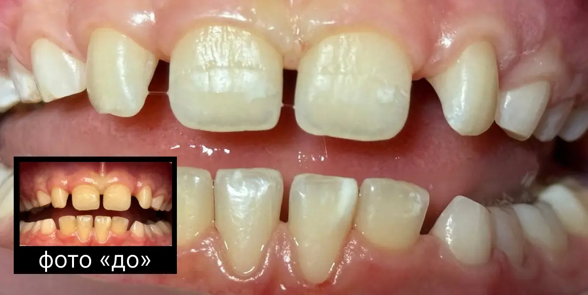 Професійна гігієна дитячих зубів: до та після