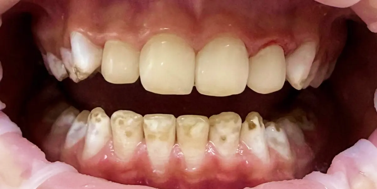 Відновлення зубів з флюорозом до та після.