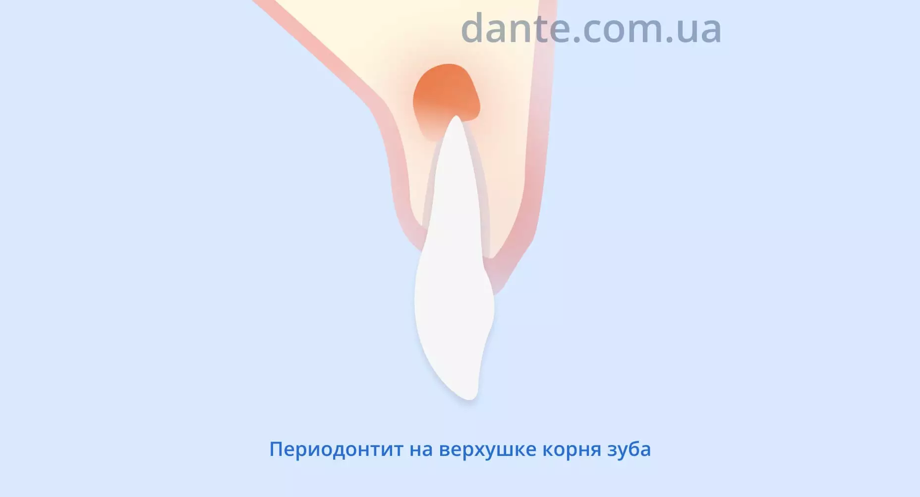 Периодонтит на верхушке корня зуба | Стоматологическая клиника D.Ante Периодонтит на верхушке корня зуба | Стоматологическая клиника D.Ante